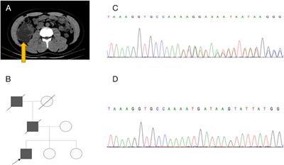 Complete Response of Hereditary Leiomyomatosis and Renal Cell Cancer (HLRCC)-Associated Renal Cell Carcinoma to Pembrolizumab Immunotherapy: A Case Report